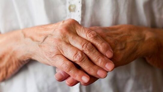 Ревматоидниот артритис предизвикува болка и оток во зглобовите на прстите. 