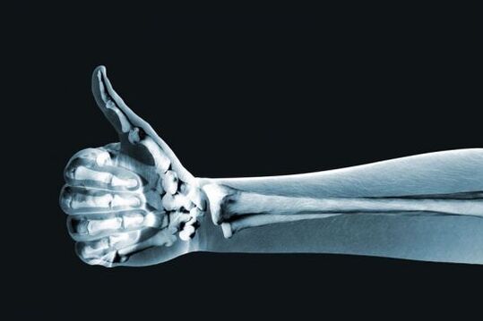 Х-зраци може да помогне да се дијагностицира болка во зглобовите на прстите
