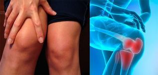 Непријатност и оток во областа на коленото се првите симптоми на артроза
