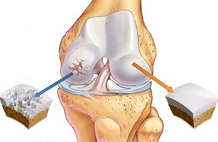 причини за артроза на колен зглоб